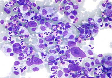 Immunotherapeutic Use Expanded to Hodgkin Lymphoma