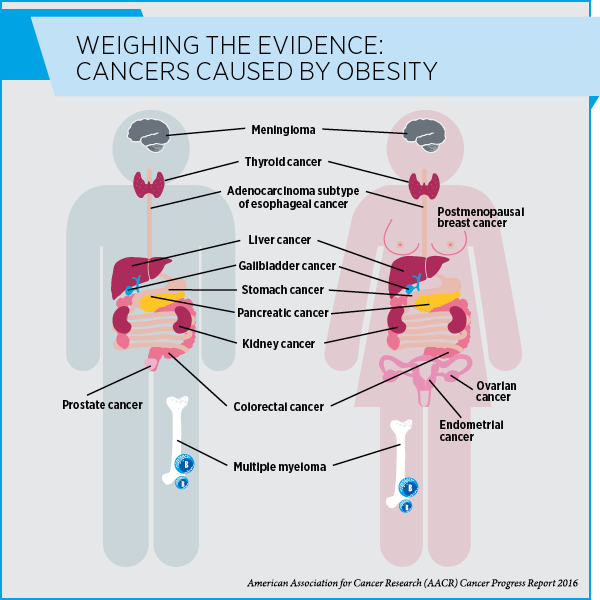 One More Reason to Stay Trim: Reduce Your Liver Cancer Risk - American ...