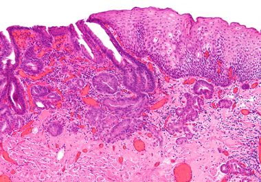 Expanding Immunotherapy to Esophageal Cancer