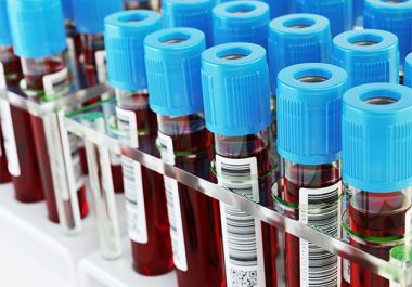 Liquid Biopsy Tests Can Identify Patients for Immunotherapy