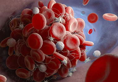 More Options to Prevent Blood Clots in High-Risk Cancer Patients