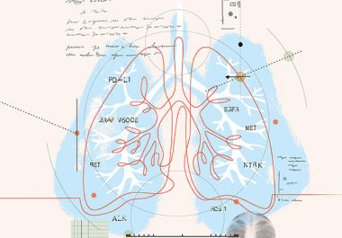 More Choices to Treat Lung Cancer