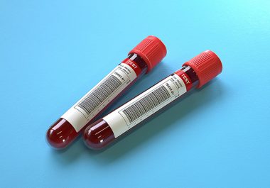 Liquid Biopsies May Ease Enrollment in Clinical Trials