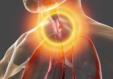 Prolonging Disease-free Survival from Esophageal and Gastroesophageal Junction Cancer 