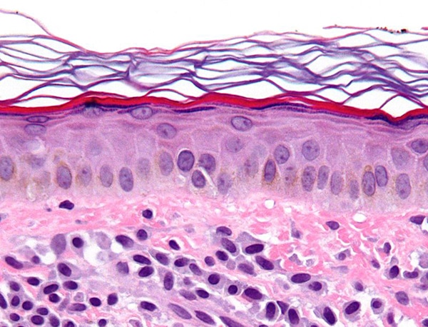 mastocytosis