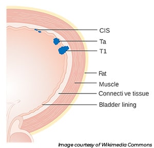 An illustrated partial cross-section of a bladder, showing the layers of bladder lining, connective tissue, muscle, and fat. Progressively larger patches of blue tumor are labeled CIS, Ta, and T1, respectively.