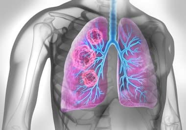 New EGFR-targeting Combination Therapy for Lung Cancer 