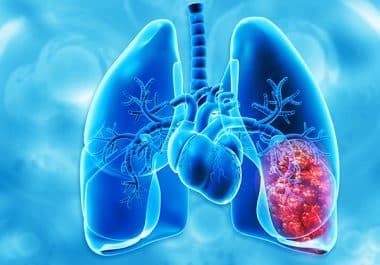 Amivantamab Plus Chemotherapy Approved for Some EGFR-mutated Lung Cancers