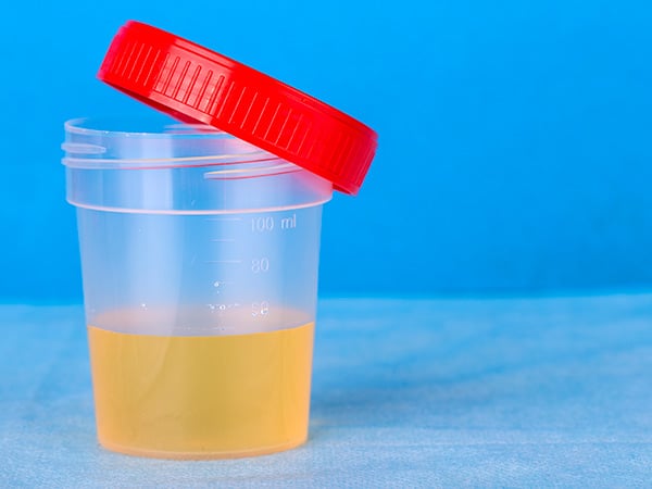 Urine Tests: Can Detecting Cancer Become Easy Pee-sy?