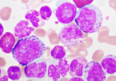 Asciminib Approved as First-line Targeted Therapy for Chronic Myeloid Leukemia