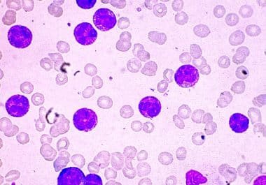 First Menin Inhibitor Approved for Certain Acute Leukemias