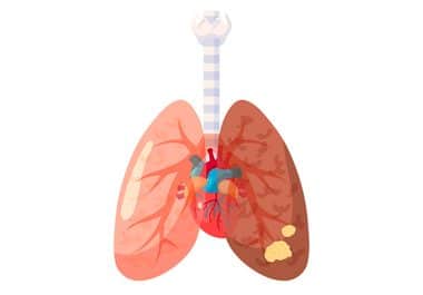 First Immunotherapy Approval for Limited-stage Small Cell Lung Cancer